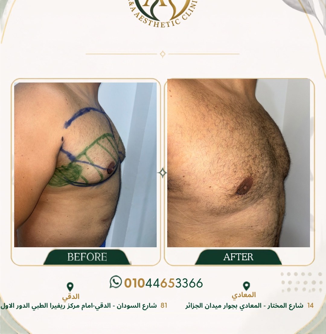 حالة تثدي رقم ١ — صورة قبل وبعد العلاج 2