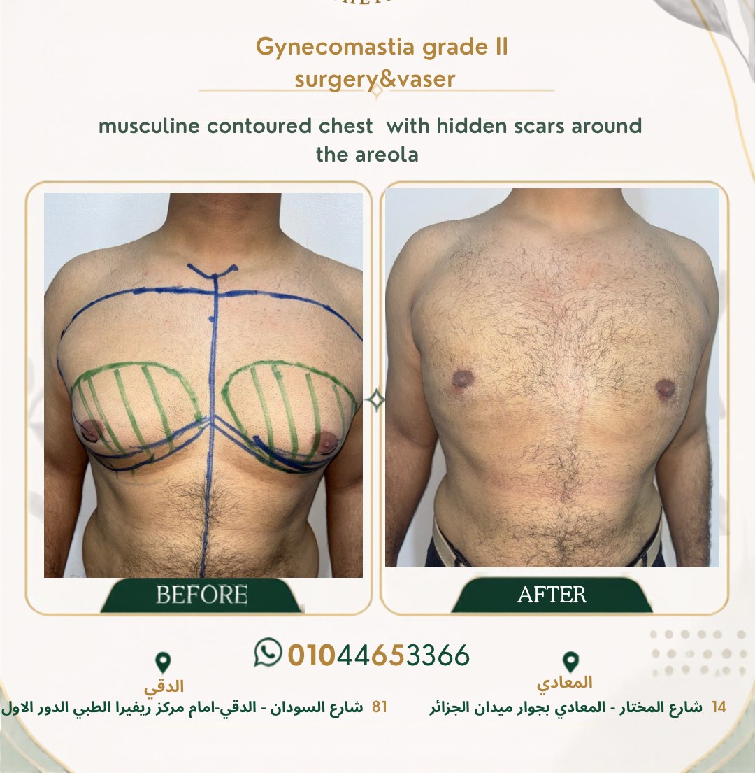 حالة تثدي رقم ٢ — صورة قبل وبعد العلاج 1
