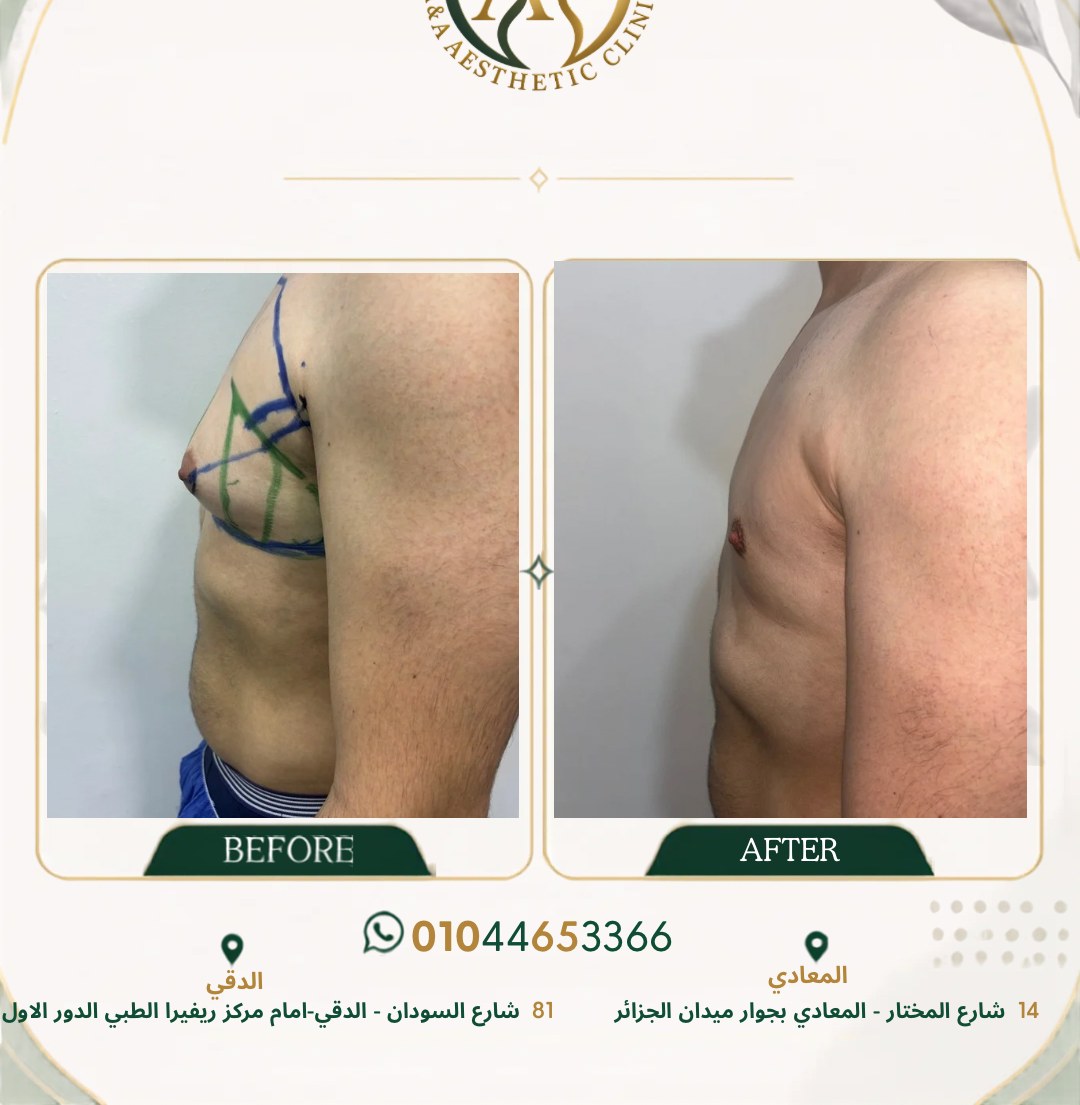 حالة تثدي رقم ٣ — صورة قبل وبعد العلاج 2