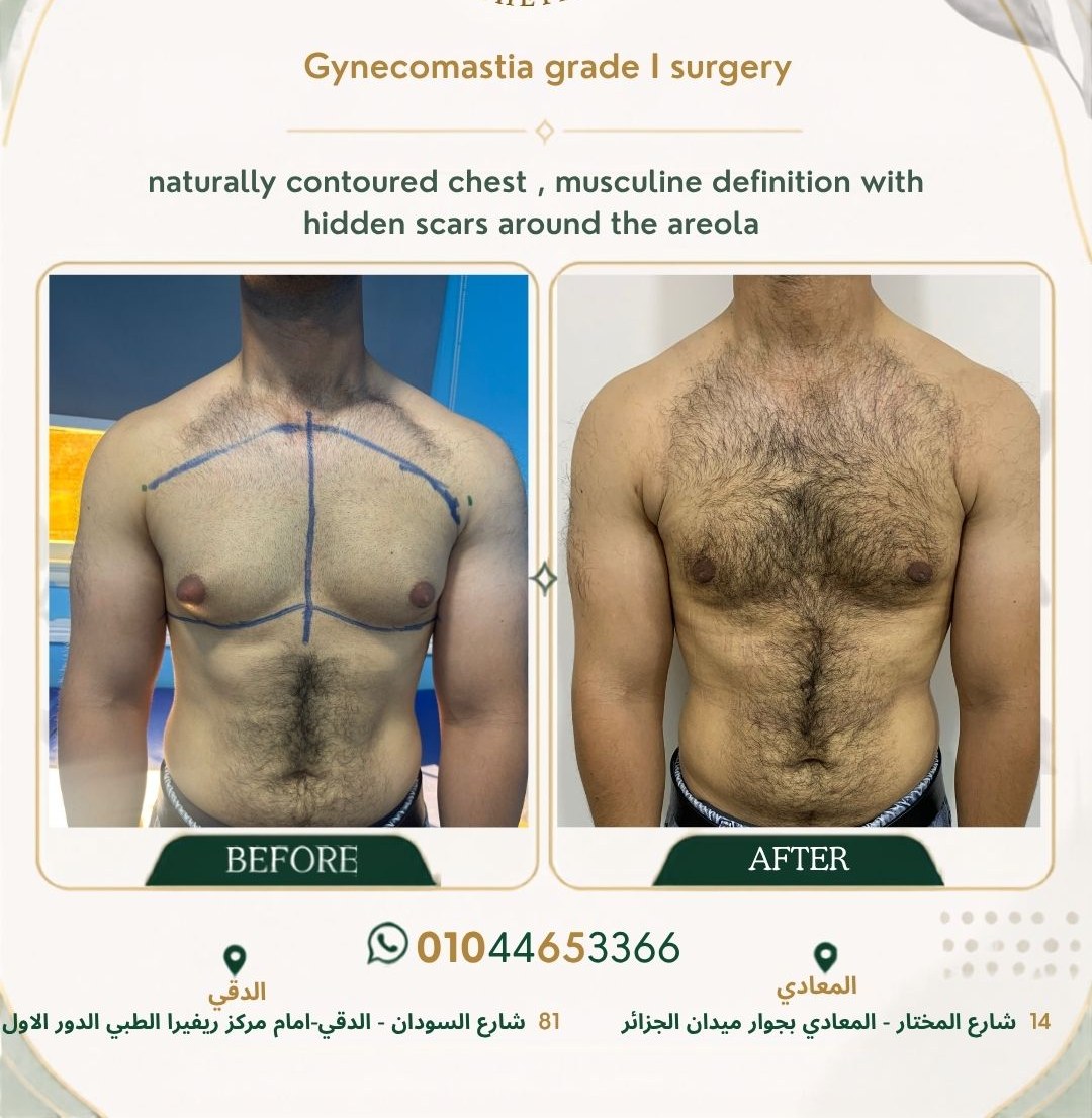 حالة تثدي رقم ٤ — صورة قبل وبعد العلاج 1