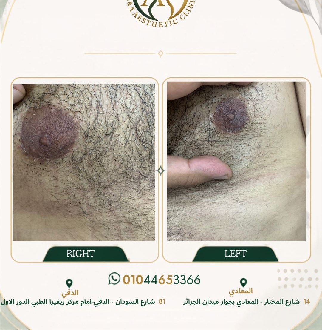 حالة تثدي رقم ٤ — صورة قبل وبعد العلاج 3