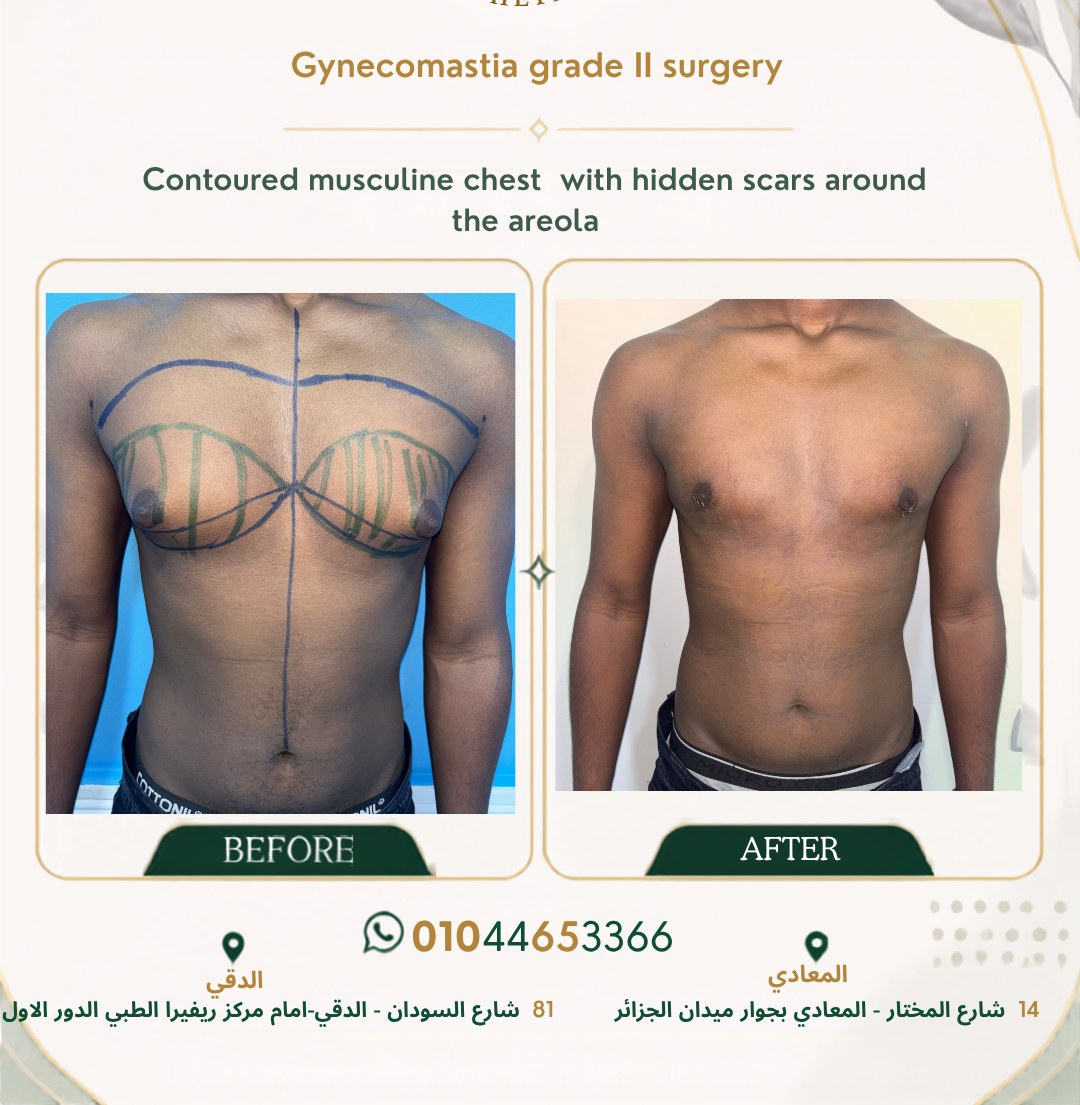 حالة تثدي رقم ٥ — صورة قبل وبعد العلاج 1