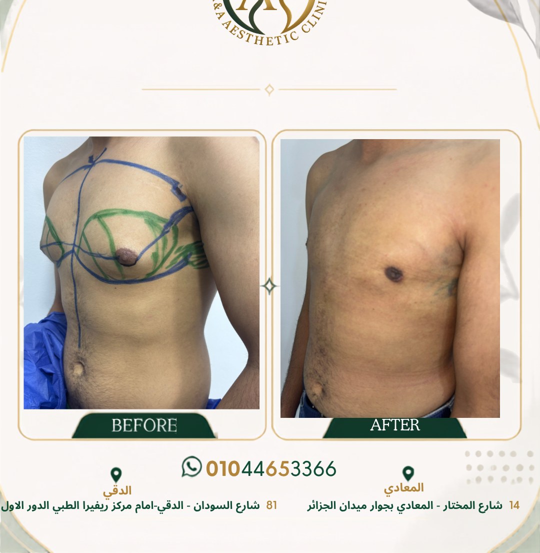 حالة تثدي رقم ٦ — صورة قبل وبعد العلاج 2
