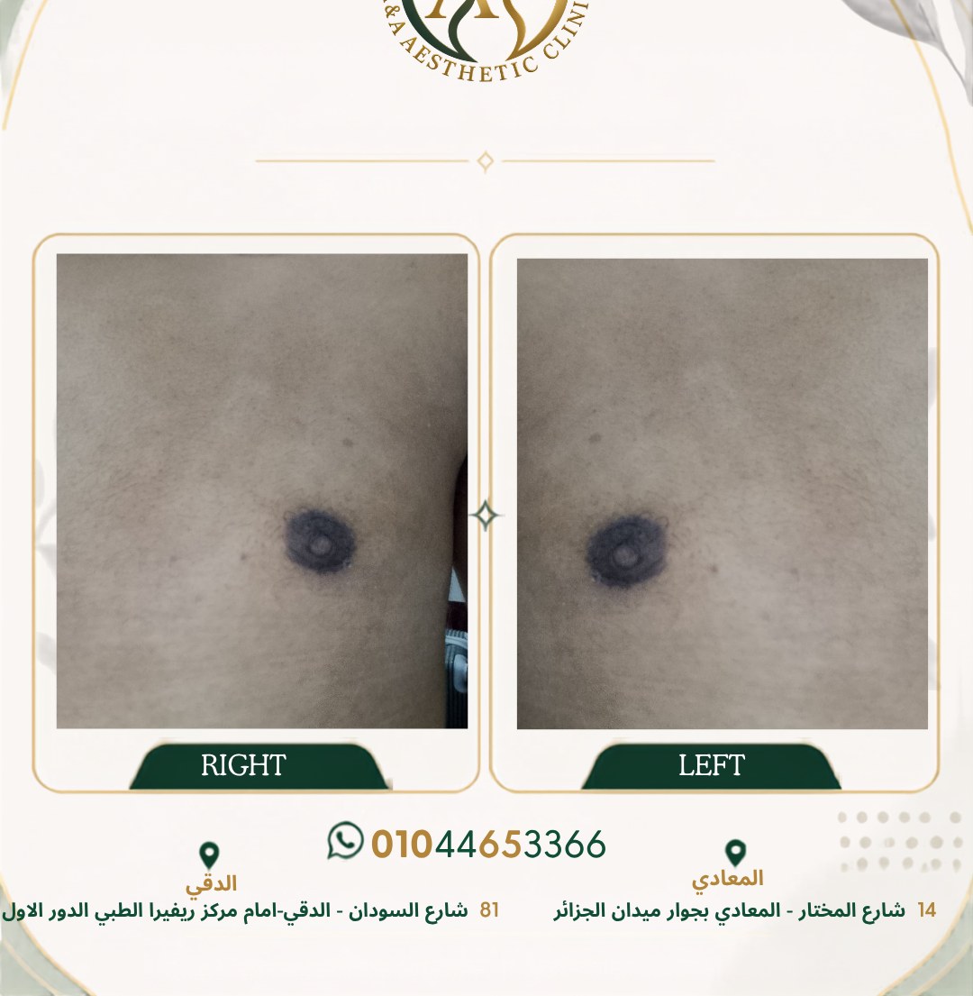 حالة تثدي رقم ٦ — صورة قبل وبعد العلاج 3