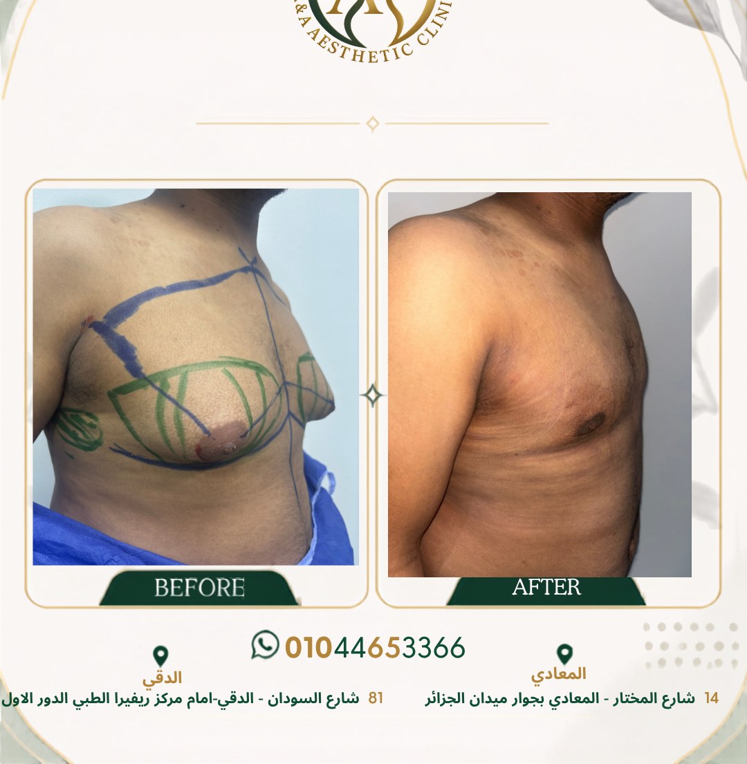 حالة تثدي رقم ٧ — صورة قبل وبعد العلاج 2