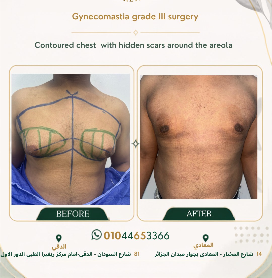 حالة تثدي رقم ٧ — صورة قبل وبعد العلاج 3